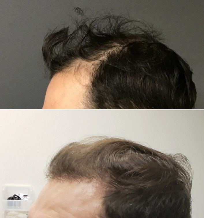 hair transplants Hamilton Ontario